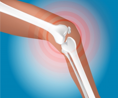 Wann hilft eine Knieorthese bei Knieschmerzen?