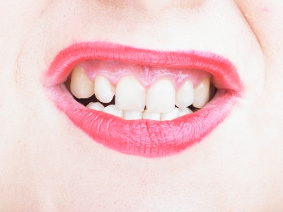 Ein Zahnbleaching macht attraktiv – aber nur bei korrekter Anwendung
