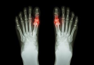 Gout , Rheumatoid Arthritis (Film X-ray Both Foot And Arthritis