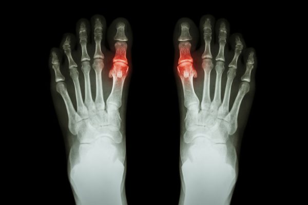 Jeder Schritt eine Qual: Arthrose im Zehengelenk des Großzehs (Hallux rigidus)